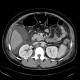 Circumarotic left renal vein: CT - Computed tomography